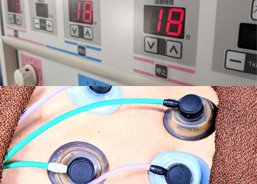 干渉電流刺激療法の画像
